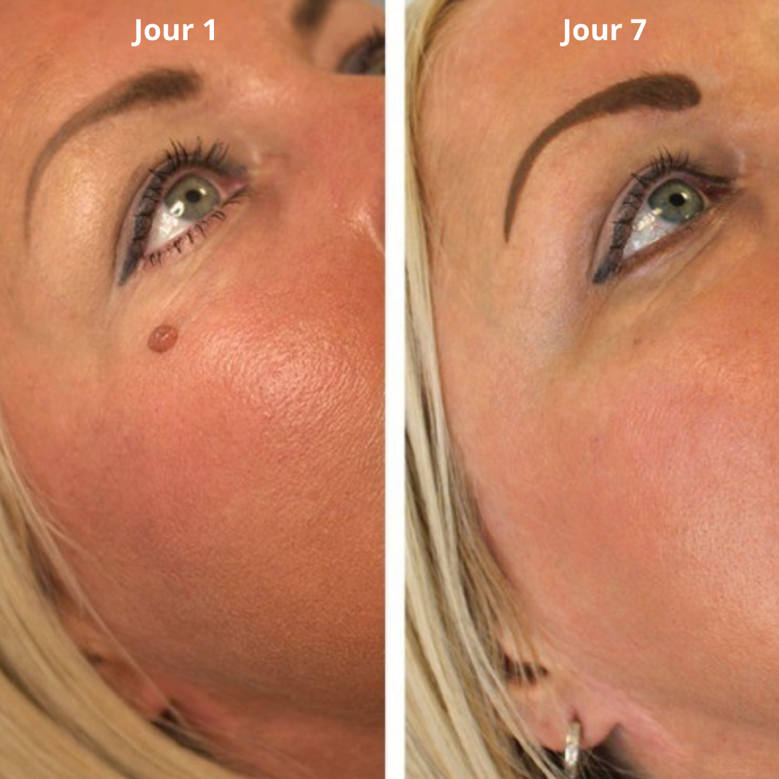 Vora® - Kit anti-excroissances